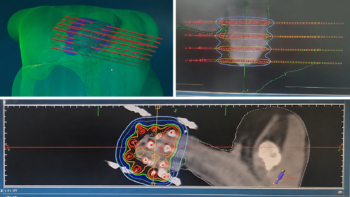 Cancer du gland : Oncorad signe une première curiethérapie guidée par impression 3D au Maroc