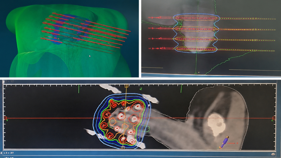 Cancer du gland : Oncorad signe une première curiethérapie guidée par impression 3D au Maroc